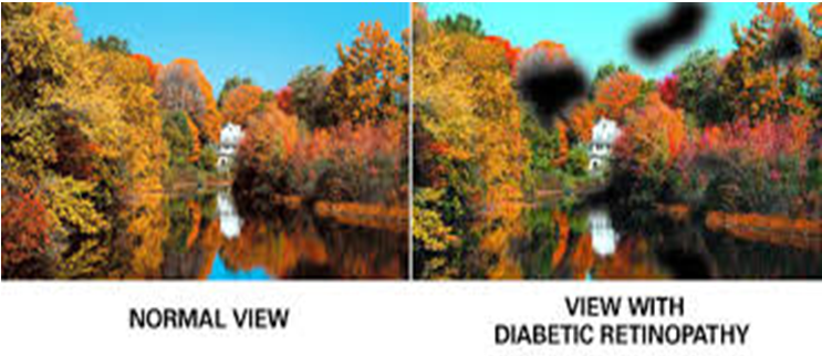 Diabetic Retinopathy Eye Surgery in Pune