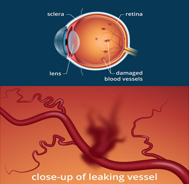 cataract eye surgery in lohegaon