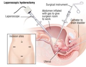 Laparoscopic Surgery in Pune