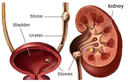 Urological Surgery in Pune