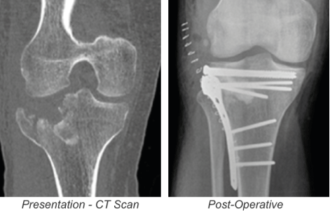 Orthopaedics Surgery in India