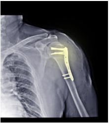 Best Orthopaedics Surgery in Pune