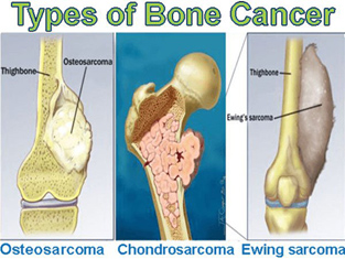 Bone Cancer