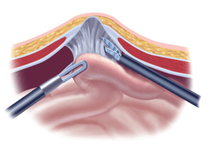 Laparoscopic Surgery in Pune