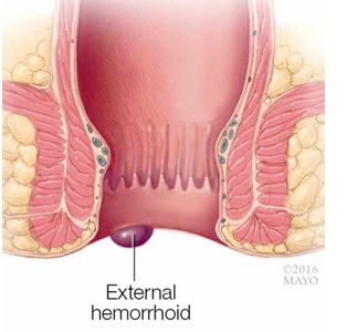 Best Laser Piles Surgery Hospital in Pune