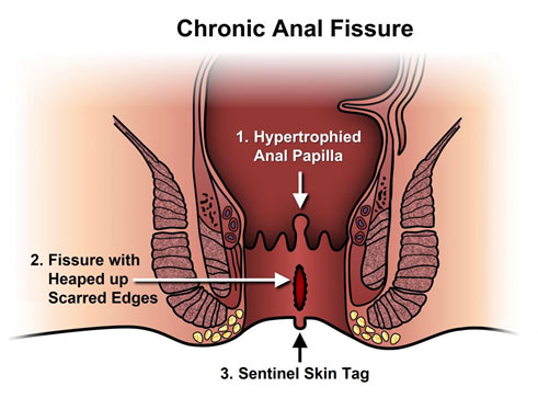 Laser Fissure Surgery in Pune