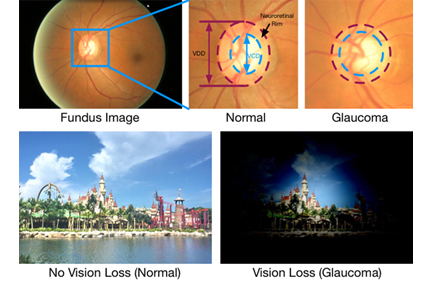 Best Glaucoma Eye Surgery in Pune