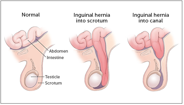 Hernia Treatment in Pune