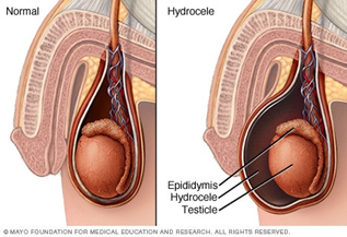 Hydrocele Surgery in Pune