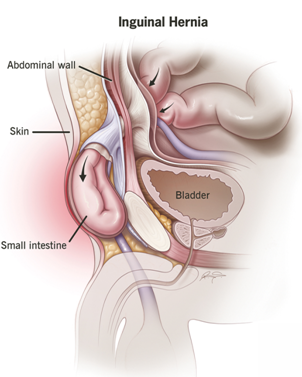 Best Hernia Treatment in Pune