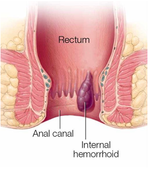 Laser Piles Surgery Hospital in Pune