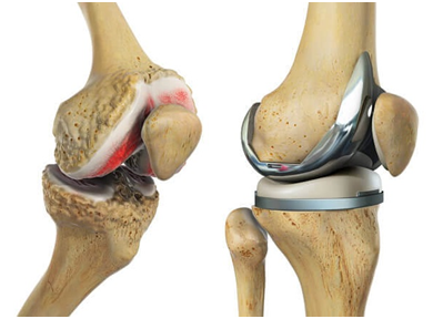 Orthopaedics Surgery in Pune