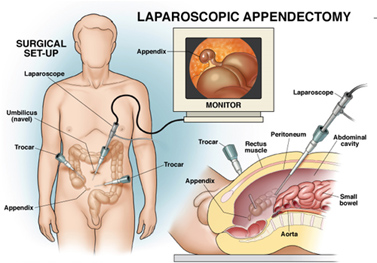 Laparoscopic Surgery in Pune