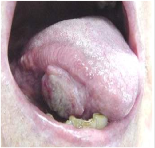 Oral Cancer Hospital in Pune