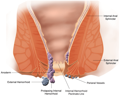 Laser Piles Surgery in Pune