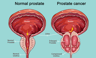 Urological Surgery in Pune