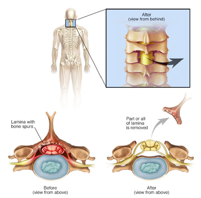 Spine Surgery in Pune