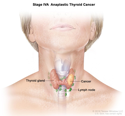 Thyroid Cancer Surgery in Pune