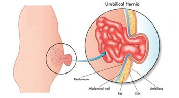 Best Hernia Treatment Hospital in Pune